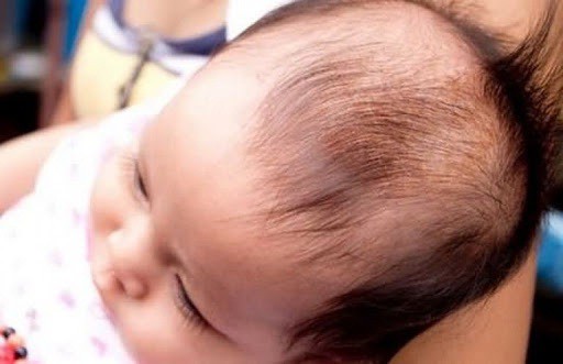 Trẻ sơ sinh bị rụng tóc ở thóp